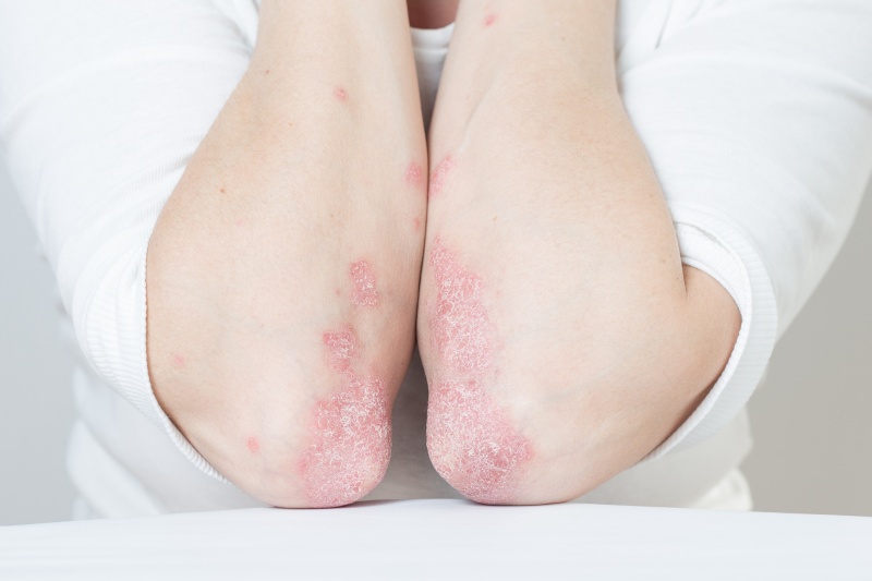Woman showing psoriasis on her elbows and forearms