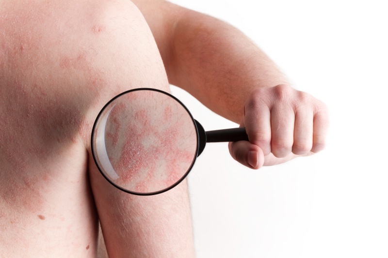 Man holding up a magnifying glass showing eczema on his arm