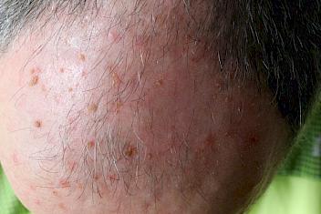 Closeup view of actinic keratosis on a man's forehead
