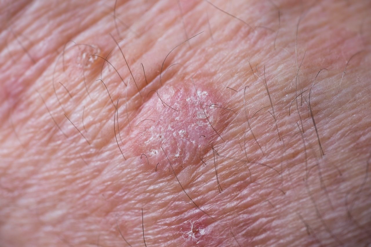 Types Of Actinic Keratosis